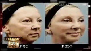 ET Canada -  Dr. Mulholland performs a FaceLift and NeckLift on ET Canada