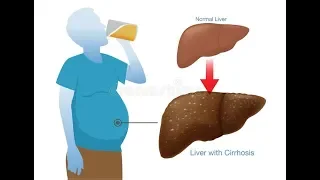АЛКОГОЛЬНЫЙ ЦИРРОЗ ПЕЧЕНИ. СИМПТОМЫ. ЛЕЧЕНИЕ
