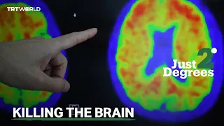 JUST 2 DEGREES: The Disease Killing Brain Cells