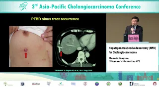 APCCA2019_012_Session 2: Hepatopancreaticoduodenectomy (HPD) for Cholangiocarcinoma