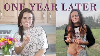 ONE YEAR Post-Op (I was living in agony)  | Let's Talk IBD