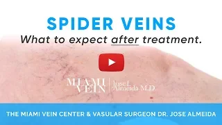 Spider Veins "What to Expect After Treatment" by the Miami Vein Center