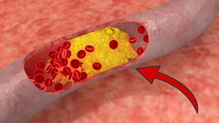 Iss DIESE 9 Lebensmittel, um deine Arterien zu säubern 💥 (überraschend) 🤯