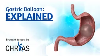 Gastric Balloon: Explained