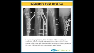 Tibial Plateau Fractures: Role of Bridging External Fixators in Proximal Tibia Fractures