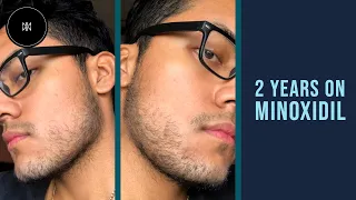 Minoxidil Beard Journey: 2 Years