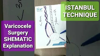 Varicocele Surgery with ISTANBUL TECHNIQUE: 20 Years Experience in Microsurgical Varicocelectomy