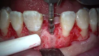 GBR, Implant placement and crown lengthening