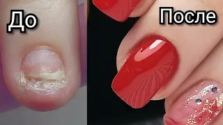 DIFFICULT REPAIR OF A RIPPED NAIL IN 5 MINUTES!