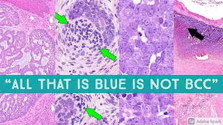 "All that is Blue is Not Basal Cell Carcinoma" - BCC vs Mimics - Dermpath Dermatology Pathology