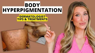 Dermatologist Explains Body Hyperpigmentation: What Causes It, Best Treatments, Prevention, & More!