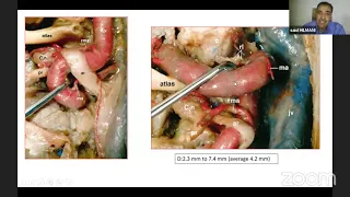 Surgical Anatomy of C1 C2 instability Posterior Approach by Prof  Hilmani