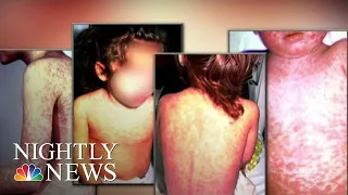 Public Health Emergency Issued After Measles Outbreak In Washington State | NBC Nightly News