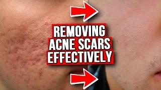 GET RID OF ACNE SCARS (FROM EXPERIENCE)