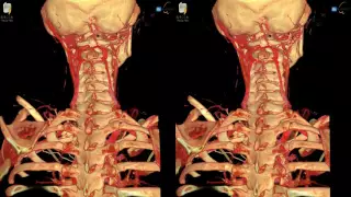Spine Fracture - 3D Virtual Tour | UCLA Neurosurgery