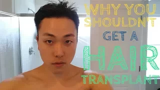 Why You Shouldn't Get A Hair Transplant
