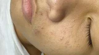 Blackhead, Acne P2 (Nghia) | Mụn Đầu Đen, Mụn Trứng Cá P2 (Nghĩa) - SacDepSpa#332