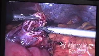 Laparoscopic Roux-en-Y Gastric Bypass Surgery by Prof. Mahmood Ayyaz at Services Hospital, Lahore