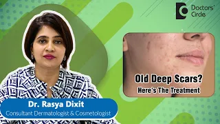 Treatment Of Deep Old Acne Scar for Clear Skin #acne #pimple   - Dr. Rasya Dixit | Doctors' Circle