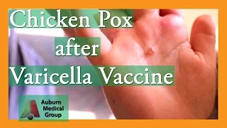 Chicken Pox after Varicella Vaccine | Auburn Medical Group