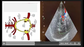 A very simple step by step approach to diagnose an acute ischemic stroke by TCCD