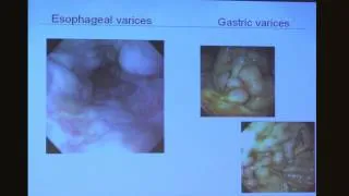 Cirrhosis - Sammy Saab, MD, MPH | UCLA Digestive Diseases