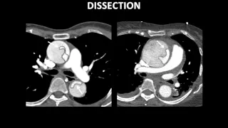 MultiModality Imaging of Acute Aortic Syndromes