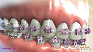 Orthodontic Braces - Different Parts (2)