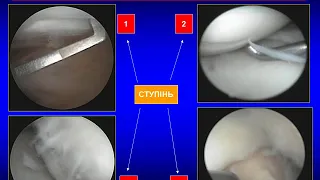 Лекція. Дегенеративно-дистрофічні захворювання суглобів