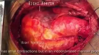 Atrial fibrillation vs Atrial Flutter