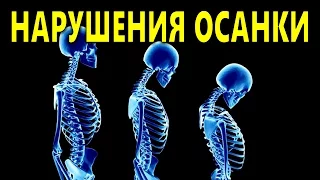 Нарушения осанки. Виды нарушений осанки у детей и взрослых.