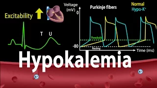 Hypokalemia: Causes, Symptoms, Effects on the Heart, Pathophysiology, Animation.