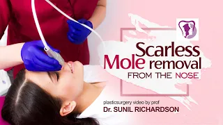 Scarless mole removal from the nose - plasticsurgery video by prof dr sunil richardson