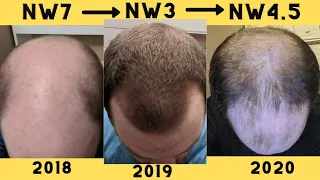 HYPER-RESPONDER TO HAIR LOSS MEDS REVERSES HAIR LOSS ONLY TO LOSE IT 2 YEARS LATER!