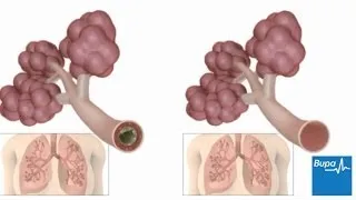 How pneumonia affects the lungs