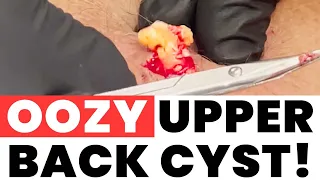 OOZY UPPER BACK CYST!