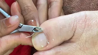 HOW TO CUT THICK TOENAILS - Toenail Cleaning Satisfying #271