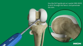 ACL Reconstruction Using the Inion Hexalon™ Screw and Inion FlipButton™