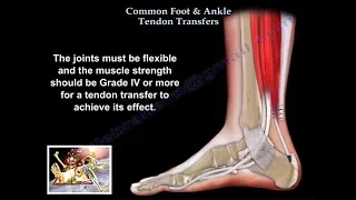 Common Foot & Ankle Tendon Transfers - Everything You Need To Know - Dr. Nabil Ebraheim