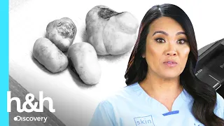 Dra. Sandra remueve enorme bultos en orejas | Dra. Sandra Lee: Especialista en piel | Discovery H&H