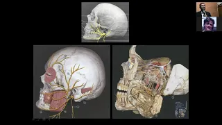 Facial Nerve Schwannoma