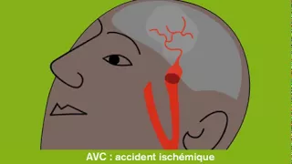 Accident vasculaire cérébral ischémique (AVC)