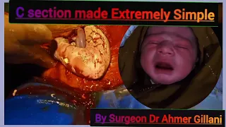 C-section/Cesaraen Delivery :Surgical Technique-HD Video/ Primary Vertex Cesaraen Sectio#csection