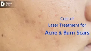 What is the cost of laser treatment for acne & burn scars? - Dr. Rasya Dixit