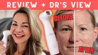 New NIRA PRO home laser review | Before and afters plus would I use it long term?