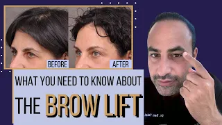 What You Need To Know About The Brow Lift | Dr. Ben Talei Beverly Hills, Los Angeles