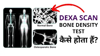 What is the Dexa Scan Bone Density Test? | How it's Done?