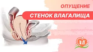 ​👉 Опущение стенок влагалища