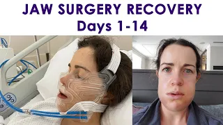 I HAD DOUBLE JAW SURGERY! Recovery Days 1-14