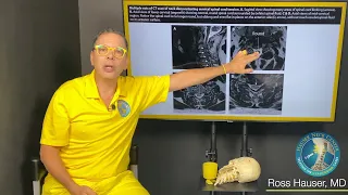 Spinal cord tension and cervical dysstructure: MRI, CT, and symptom discussion with Ross Hauser, MD